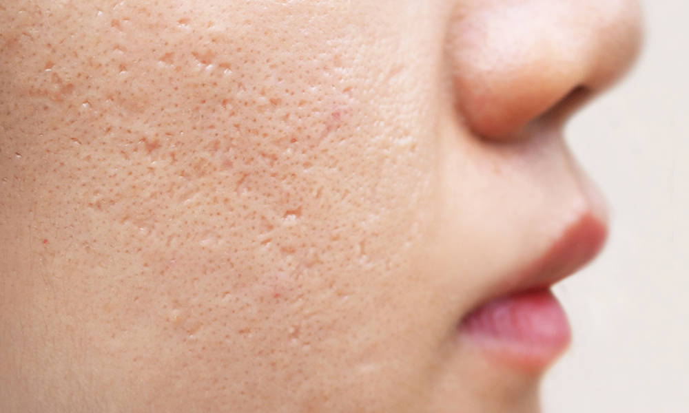 Get Rid of Acne Scars – Know How to Treat It?