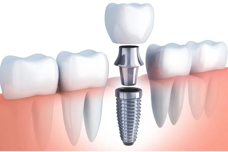 Aftercare Tips- Dental Implants