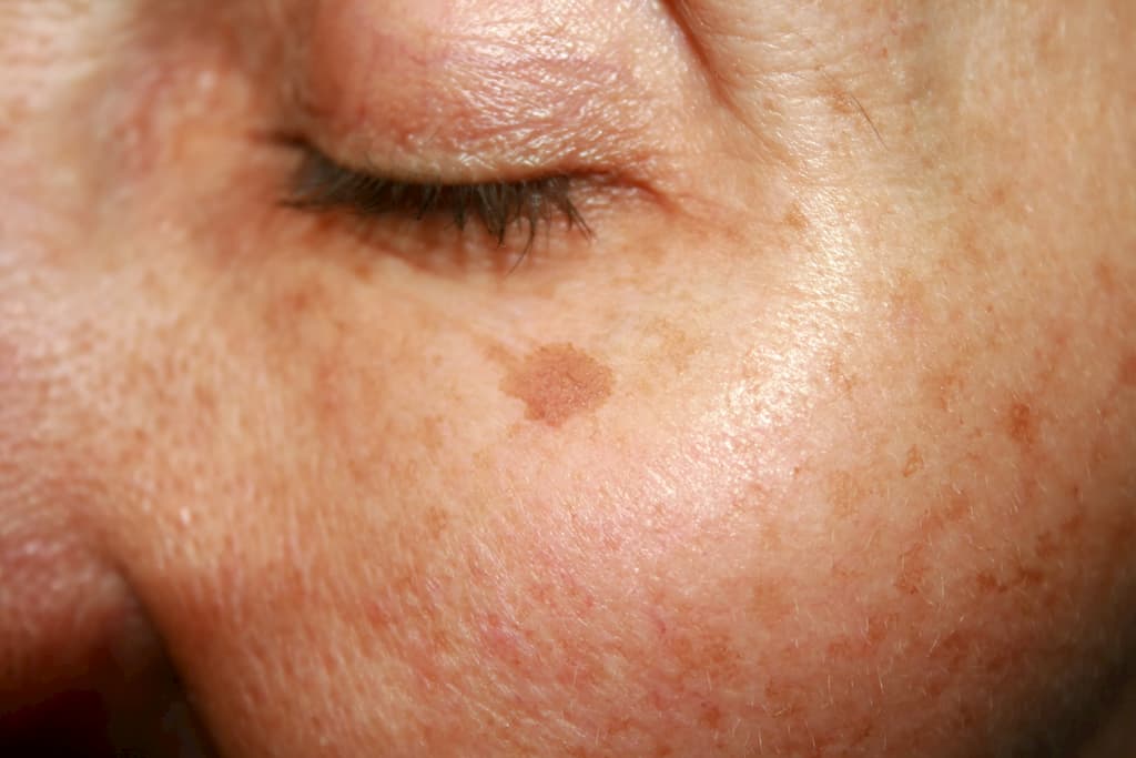 Glowing Confidence: Dark Spot Skin Treatment Explained