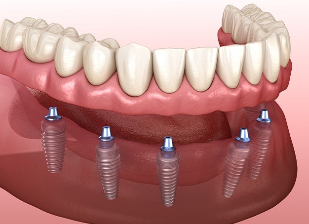 Would You Benefit from Implant Retained Dentures?